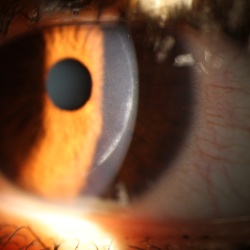 Refractive