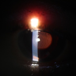 Iris/Pupil