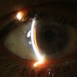 Glaucoma