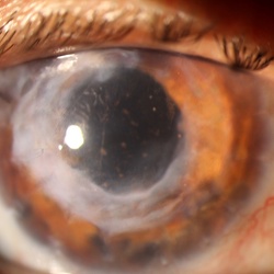 Cornea
