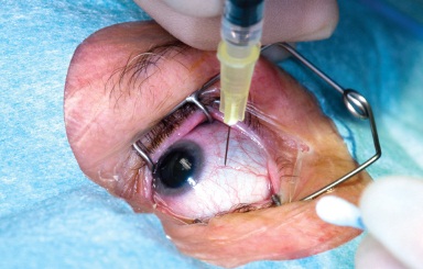 intravitreal injection